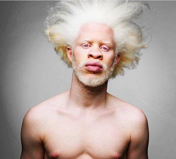 7. Jewell Jeffrey, en ünlü albino insanlardan birisi.