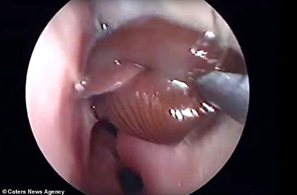 Doktor önce kan emici olan bu sülüğü cımbız kullanarak hareket ettirdi ve hala canlıyken hastanın burnundan çıkarttı.