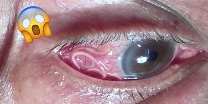 Gittiği Doktorda Gözünde 15 Santimetrelik Bir Solucan Olduğunu Öğrenen Adam