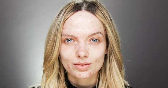 Свободу акне, или новая мода в Инстаграме: Покажи дефекты кожи, не стесняясь