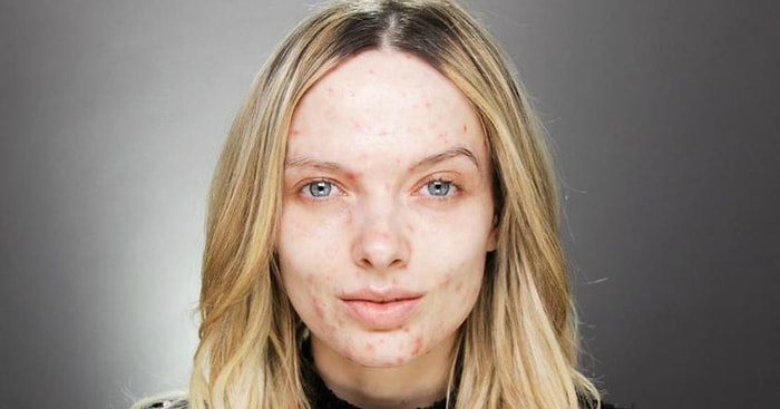 Свободу акне, или новая мода в Инстаграме: Покажи дефекты кожи, не стесняясь