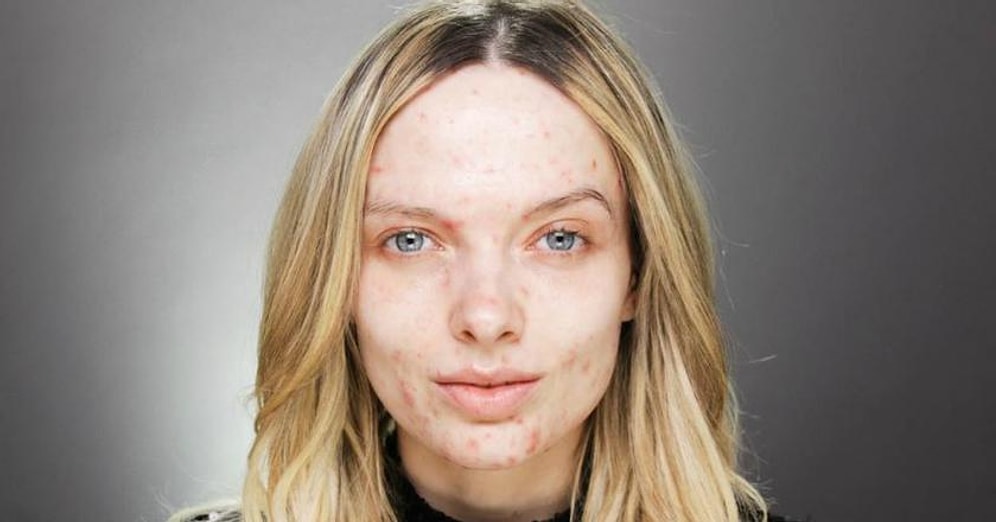 Свободу акне, или новая мода в Инстаграме: Покажи дефекты кожи, не стесняясь