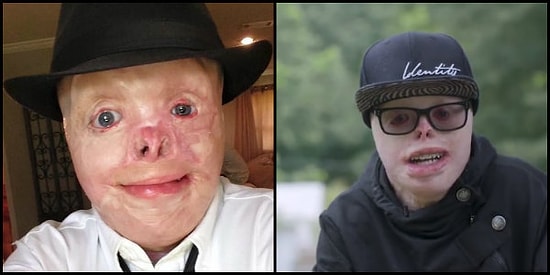 İsteyin Yeter! Vücudunun %95'i Yanıklarla Kaplı Genç, Model Olma Hayalini Gerçekleştirdi!