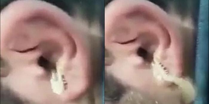 Kulağakaçan Efsanesi Gerçek Oldu! Bir Adamın Kulağından Devasa Boyutta Kırkayak Çıkartıldı