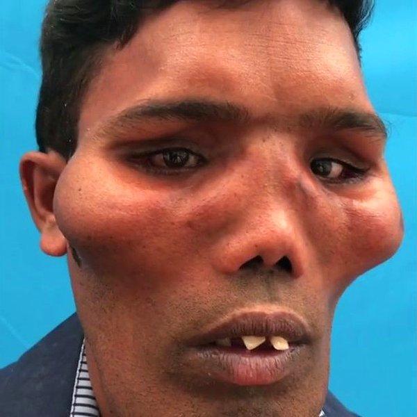 Milyonda bir görülen Aslan Surat Sendromu'ndan muzdarip adam yüzünü yeniden yapılandırdı.
