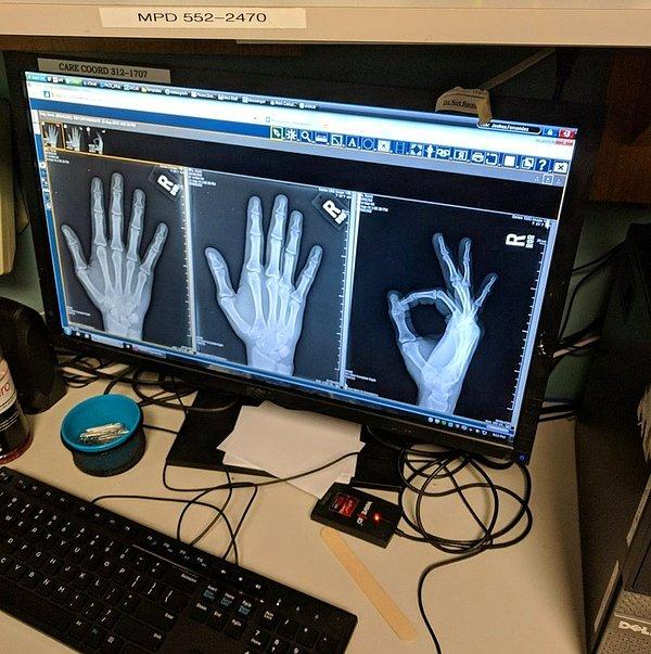 4. "Serçe parmağımı kırdım ama hemen bir röntgen çektirdim."