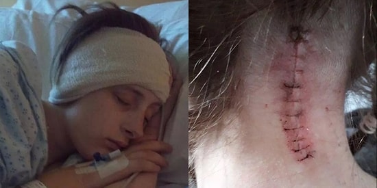 İki Yıldır Kendisini Sarhoş Gibi Hisseden Genç Kadında Beyincik Sarkması Hastalığı Olduğu Ortaya Çıktı!