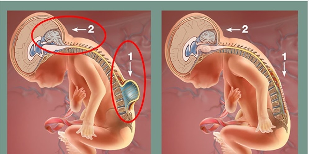 Folik Asit Tüketimi ve Planlı Gebelikle Önlenebileceği Düşünülen Spina Bifida Hastalığını Duymuş muydunuz?