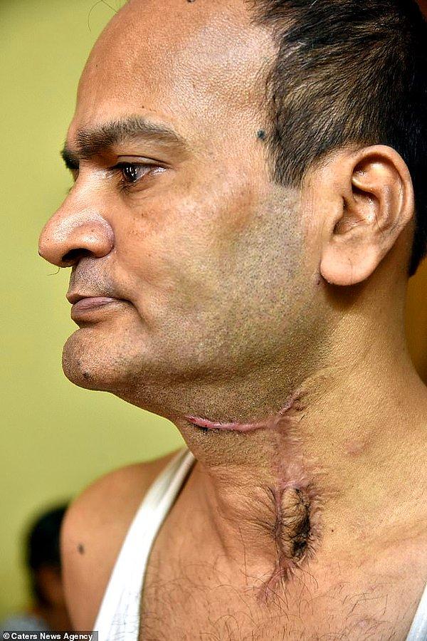 Hindistanlı bir adam üç yıl aradan sonra yeniden yemek yiyebilir hale geldi. 46 yaşındaki Deepak Nandi, üç yıl önce takma dişlerini yuttuğunda yemek borusuna o kadar büyük zarar verdi ki, tüplerle beslenmek zorunda kaldı.