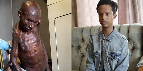 Vücutlarını Yavaş Yavaş Taşa Dönüştüren Hastalıkla Savaşan İnsanların Yürekleri Dağlayan Hikayeleri