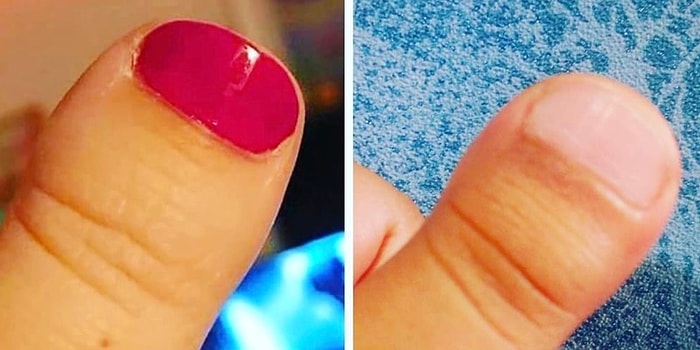 «Что с твоим пальцем?!»: 18 шуток, которые прекрасно поймут обладатели миниатюрных больших пальцев на руках