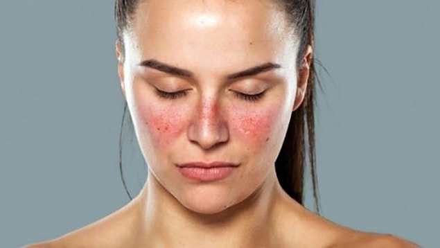 Peki Lupus hastalığı nedir?