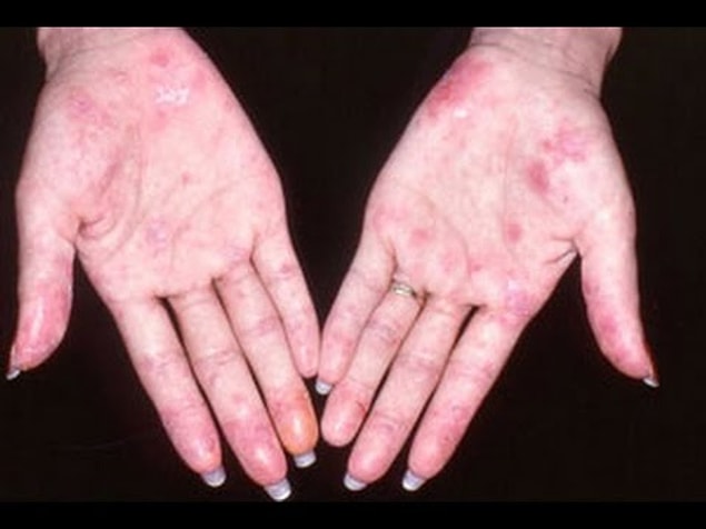 Lupus(SLE) hastalığının belirtileri nelerdir?