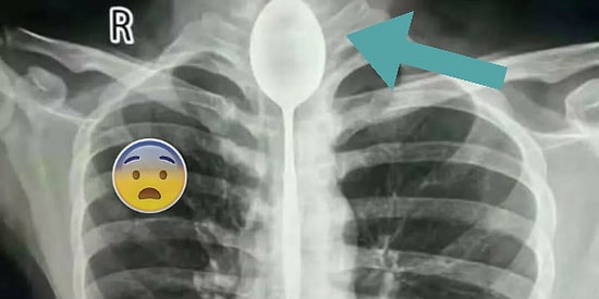 Pes Doğrusu! İddia Üzerine Yuttuğu ve Soluk Borusuna Takılan Kaşıkla Bir Sene Yaşayan Çocuk