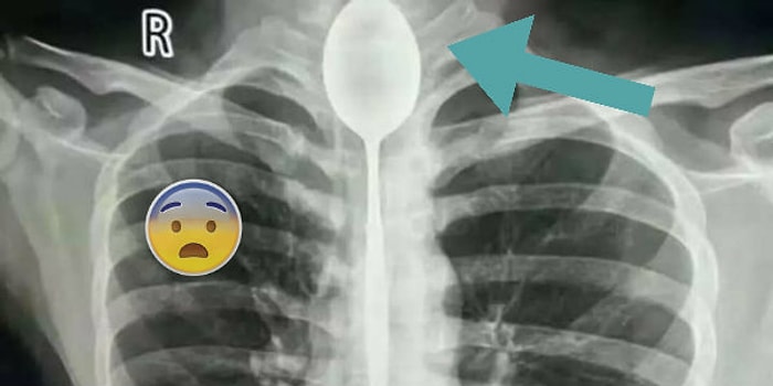 Pes Doğrusu! İddia Üzerine Yuttuğu ve Soluk Borusuna Takılan Kaşıkla Bir Sene Yaşayan Çocuk