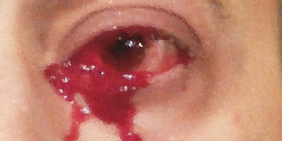 Resmen Kan Ağladı! Kabus Gibi Bir Saat Geçiren Adamın Gözünde Tümör Olduğu Tespit Edildi