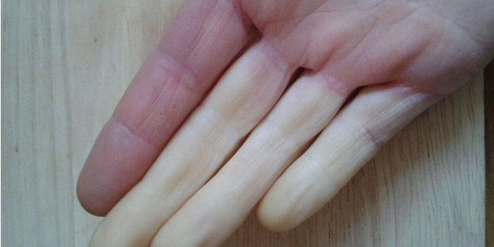 Sadece Raynaud Hastalığına Sahip Olanların Anlayabileceği İçinizi Soğutacak 16 Durum!