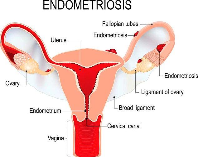 3. Endometriyoz