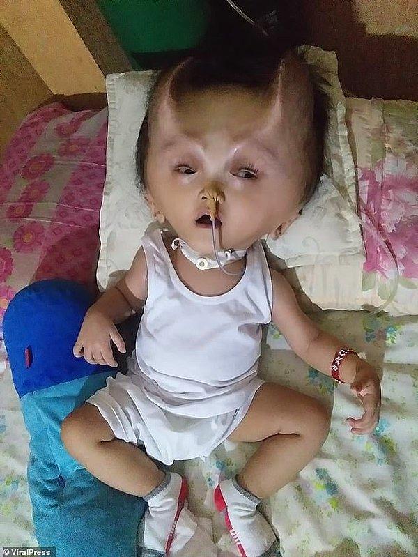 Clyne bebek, Mart ayında Filipin Çocuk Hastanesinde, beynindeki baskıyı azaltması için bir ameliyat olmuş.