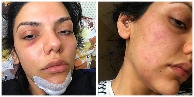 5. Kadına şiddet her yerde - Sunucu Eda Pera Küçük 'ün oyuncu Tolga Pancaroğlu'ndan şiddet gördüğü iddiası