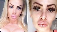 Yine Bir Estetik Sorunu: Dolgu Yaptıran Barbie Özentisi Kadının Dudakları Adeta Çiğ Ete Dönüştü!