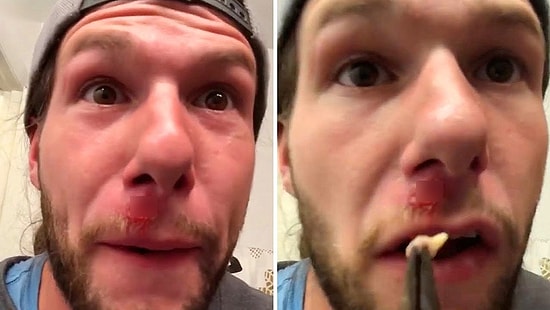 Üst Dudağının Üzerinden Çıkardığı Nesne İle Mide Bulandırıcı Bir Görüntü Sergileyen Adam