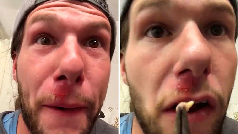 Üst Dudağının Üzerinden Çıkardığı Nesne İle Mide Bulandırıcı Bir Görüntü Sergileyen Adam