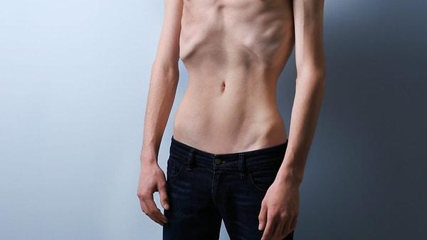 Anoreksiya Nervoza, çoğunlukla ergenlik çağında başlar, özellikle genç kadınlarda sıkça görülür.