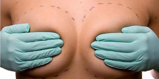 Uzmanlara Göre Meme İmplantı Kanser, Düşük ve Eklem Yangısı İhtimalini Arttırıyor!