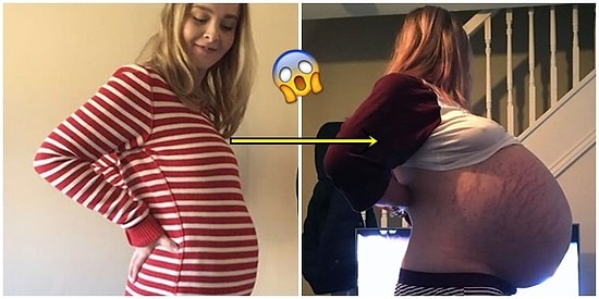 Bebek Zannettiler Kist Çıktı: Genç Kadının Karnındaki 26 Kiloluk Kist Doktorları Bile Şaşırttı!