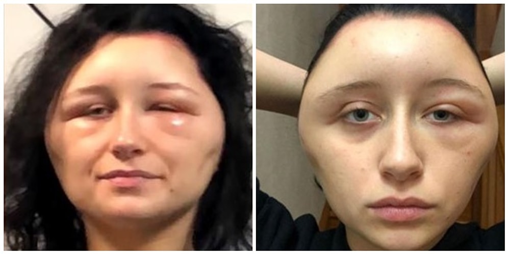 Девушка захотела покрасить волосы и чуть не умерла от аллергической реакции