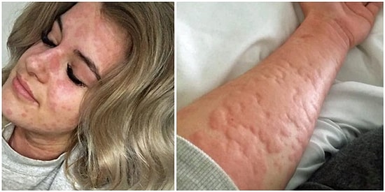 Kendini Isıtmanın Yolunu Bulamazsa Ölebilir! Kış Mevsimine Alerjisi Olan 21 Yaşındaki Kadın