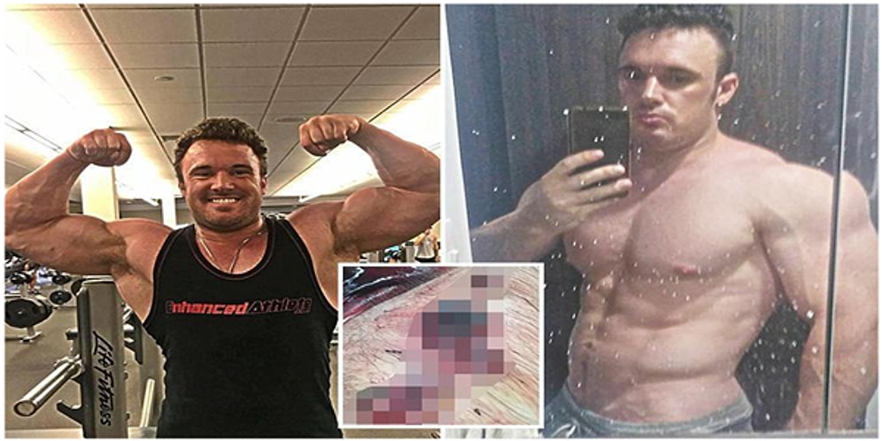 Hayatı Kabusa Döndü: Bilinçsiz Streoid Kullanımı Yüzünden Bacağından Olan Sporcu