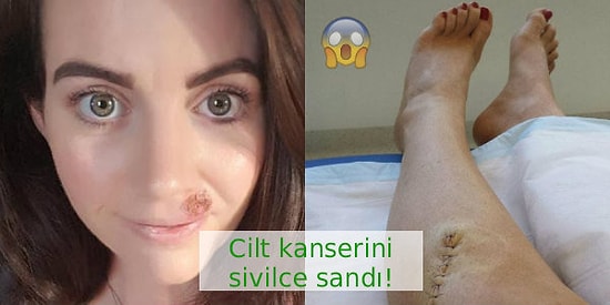 Erken Teşhis Yine Hayat Kurtardı: Yüzünde Görülen Kanser Belirtisi Yarayı Sivilce Zanneden Kadın