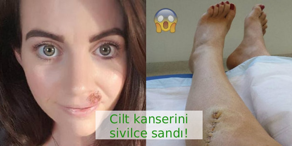 Erken Teşhis Yine Hayat Kurtardı: Yüzünde Görülen Kanser Belirtisi Yarayı Sivilce Zanneden Kadın
