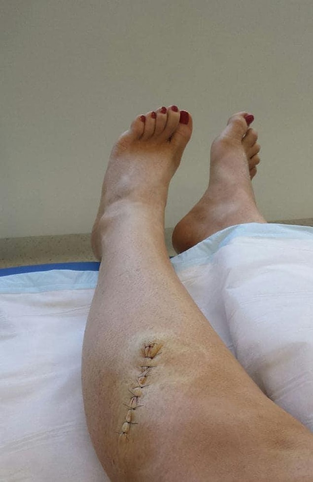 Jess'in yüzündeki sivilceye benzer cilt kanseri belirtisinden önce, bir yıl boyunca savaştığı kanserin sinyalini veren iz bacağında çıkmış.