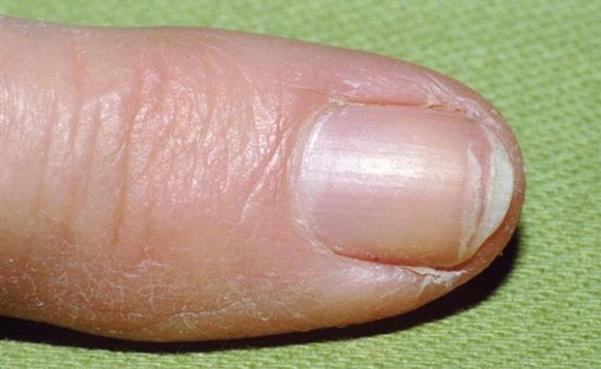 Почему ногти становятся тонкими. Онихорексис трахионихия. Онихорексис онихомикоз. Онихошизис ногтевой пластины.