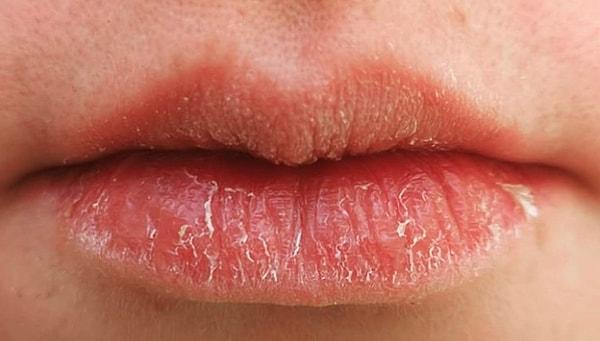 Kurumuş dudaklar anemiye işaret ediyor olabilir.