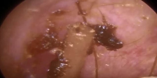 Kulağını Temizletmek İçin Hastaneye Giden Adamın Kulağından Plastik Kıyafet Etiketi Çıktı!