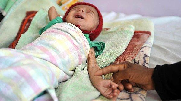 85. Save the Children raporu, savaşın hüküm sürdüğü Yemen'de açlığın ulaştığı korkunç boyutu ortaya koydu. Son 3 yılda 5 yaşın altındaki 85 bin çocuğun yetersiz beslenme nedeniyle hayatını kaybettiği aktarıldı.