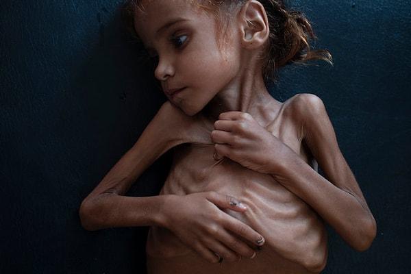 Fotoğrafı çekildikten kısa süre sonra beslenme bozukluğu yüzünden hayata gözlerini yuman Amal Hussain.