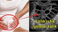 Kadınlarda En Sık Görülen Hastalıklardan Biri Olan Polikistik Over Sendromu ve Tedavisi Hakkında Bilmeniz Gerekenler