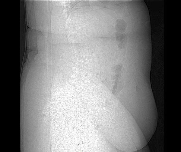 9. Obezitesi olan bir insanın röntgeni. Yumuşak doku fazlalığı alttaki kemikleri görmeyi engelliyor: