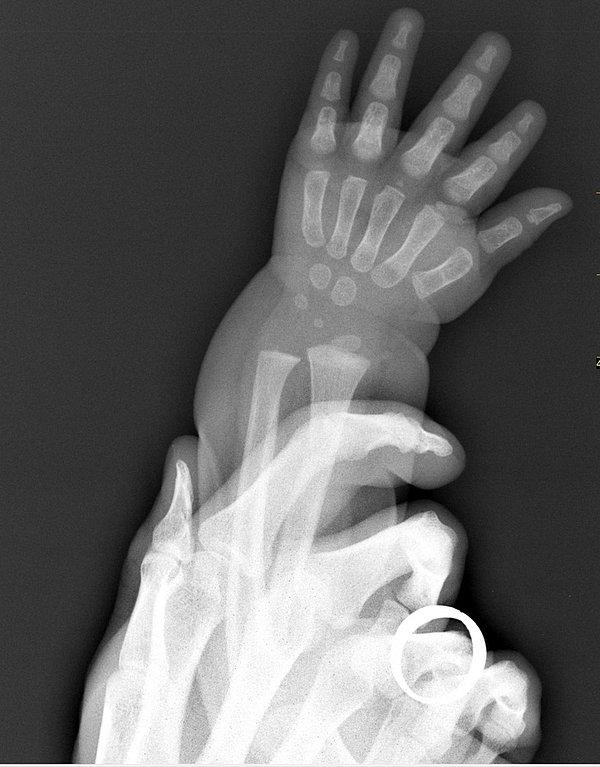 10. Bir çocuğun ve yetişkinin ellerinin röntgeni: