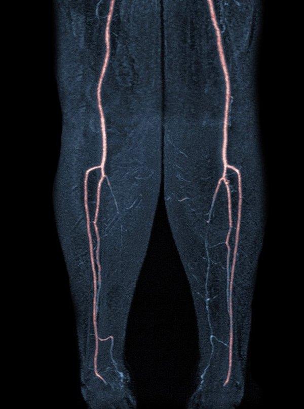 11. Sol bacaktaki damar tıkanıklıklarını gösteren bir görsel: