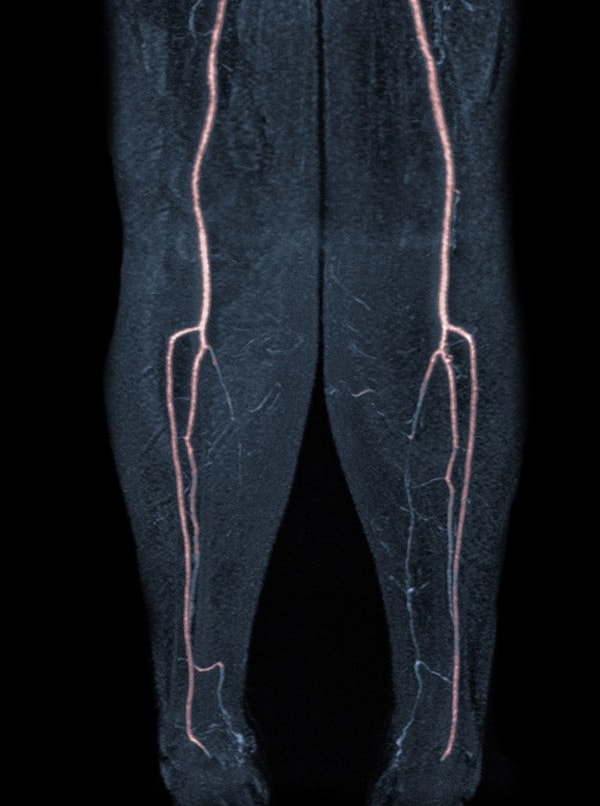 11. Sol bacaktaki damar tıkanıklıklarını gösteren bir görsel: