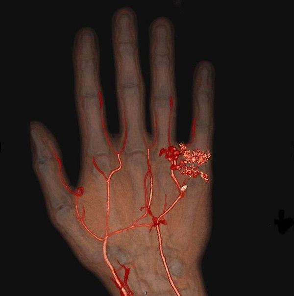 13. Damarların biçimsizleşmesini gösteren bir tomografi: