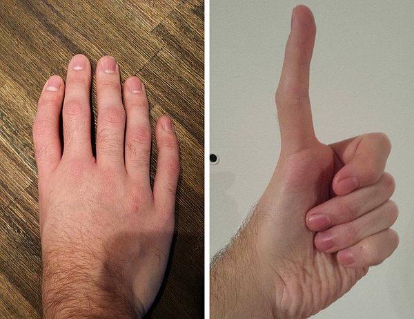 2. Triphalangeal tumb, baş parmaklarda ekstra kemikler bulunmasına ve baş parmağın diğer parmaklara benzemesine sebep olur.