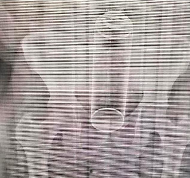 40-year-old man rushed and had to undergo emergency surgery after air freshener stuck in his bottom.