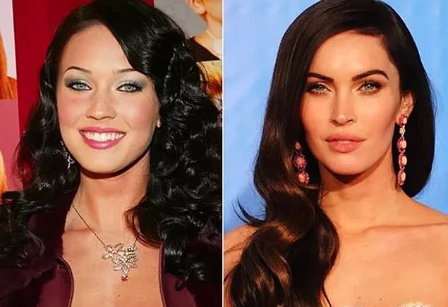 Peki, nedir bu masseter botoks?